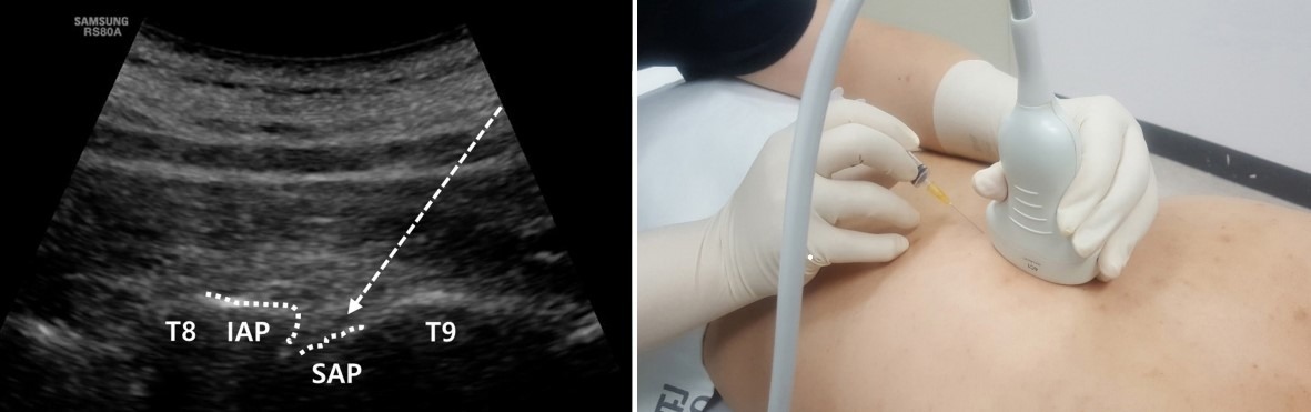 عکس تزریق تحت گاید سونوگرافی