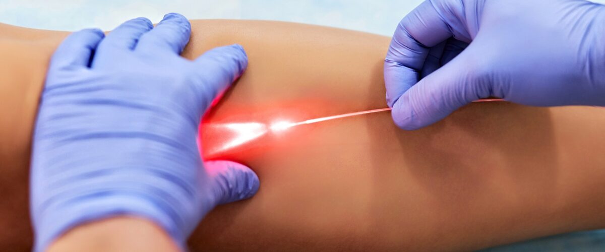 لیزرتراپی داخل عروق