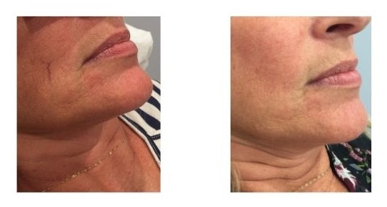 اسکلروتراپی صورت - عکس