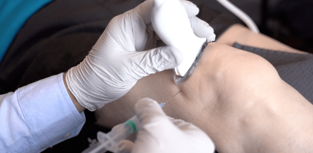 تزریق آرتروماسید تحت سونوگرافی