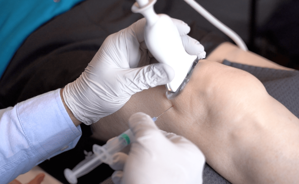 تزریق آرتروماسید تحت سونوگرافی