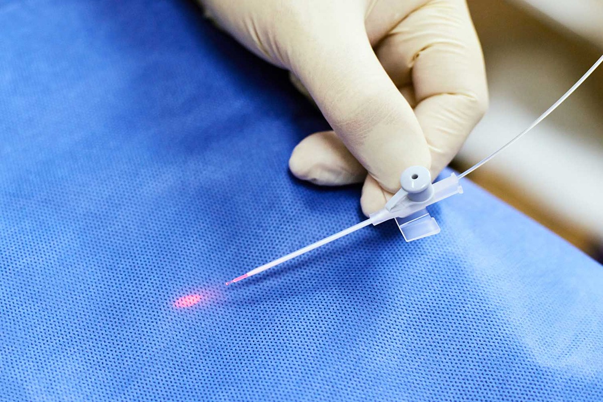 درمان واریس با لیزر