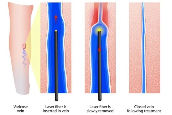 عکس درمان واریس با لیزر