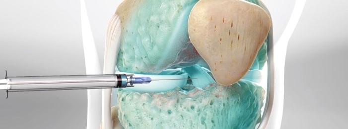 عکس نمونه تزریق مفصل زانو