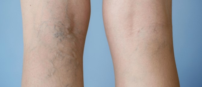 عکس واریس عنکبوتی