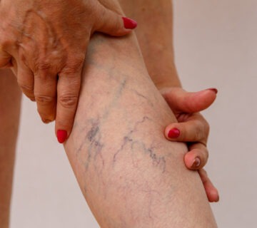 واریس عنکبوتی