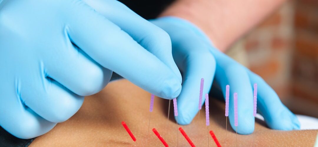 سوزن درمانی