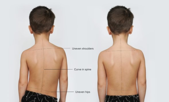 عکس انحراف ستون فقرات کودکان