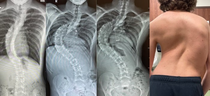 عکس انحراف ستون فقرات