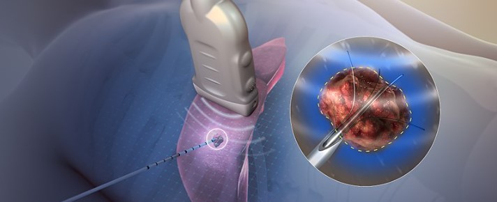 عکس درمان واریس با rf