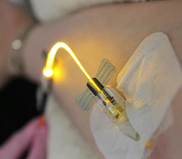 عکس لیزر داخل عروقی