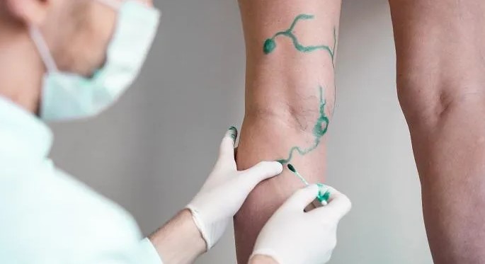 قبل عمل فلبوتومی