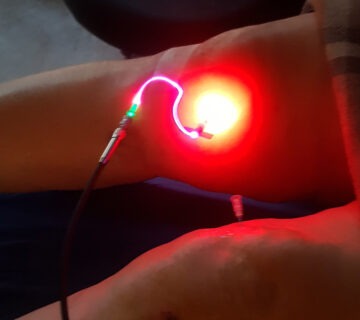 لیزر داخل عروقی