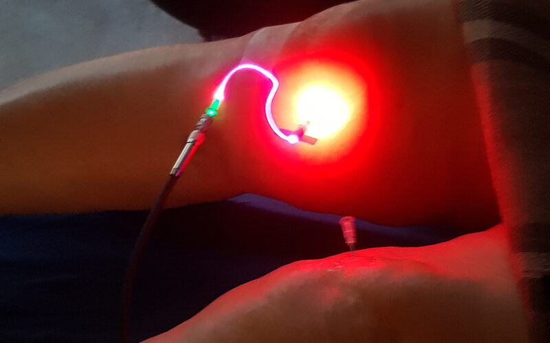 لیزر داخل عروقی