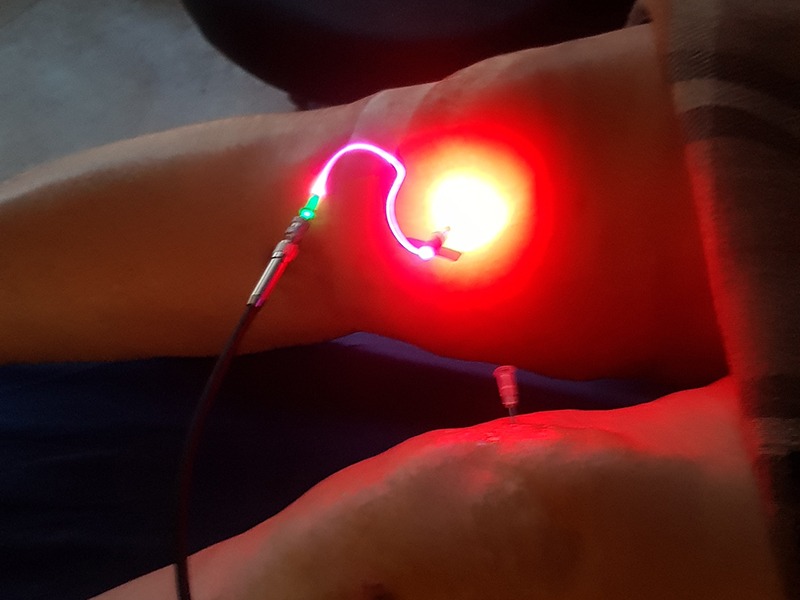 لیزر داخل عروقی