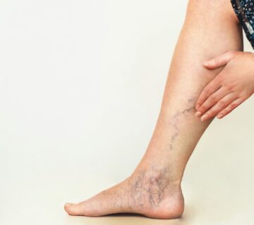 درمان واریس در تبریز