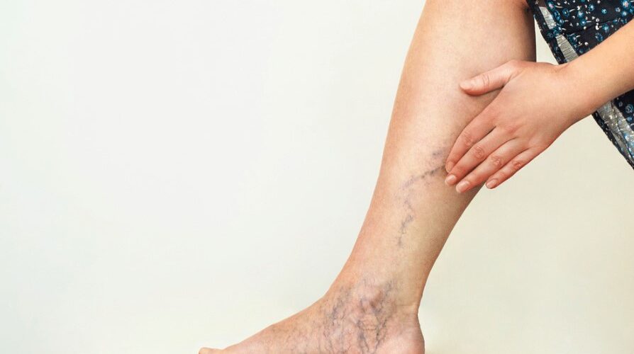 درمان واریس در تبریز