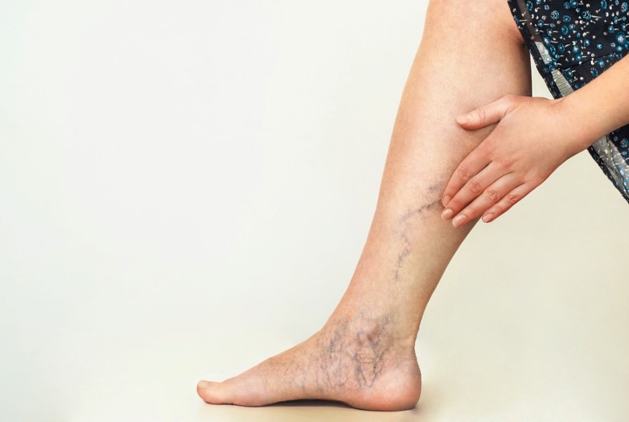 درمان واریس در تبریز