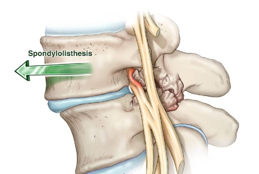 لغزش مهره ستون فقرات