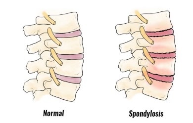 عکس اسپوندیلوز
