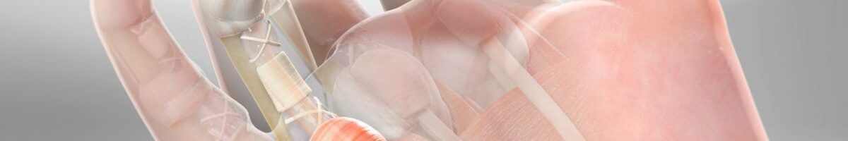 انگشت ماشه ای