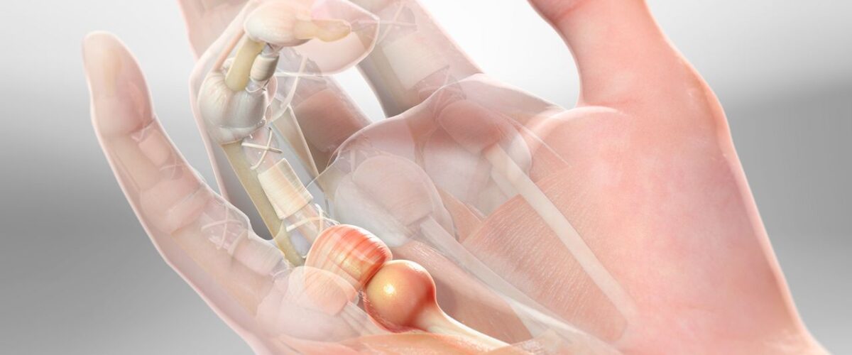 انگشت ماشه ای