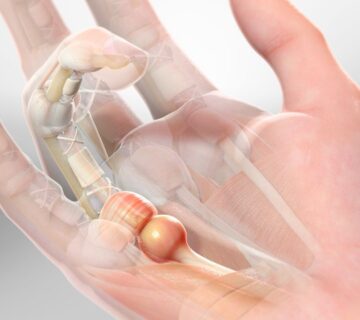 انگشت ماشه ای