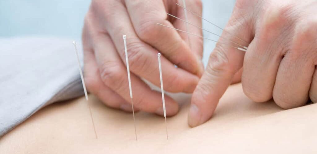 سوزن درمانی عصب سیاتیک