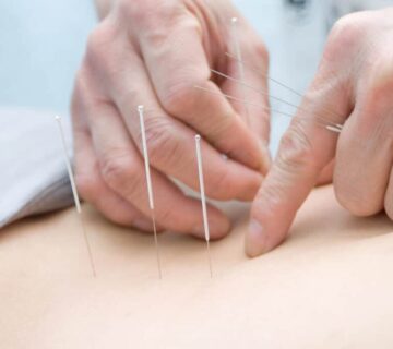 سوزن درمانی عصب سیاتیک