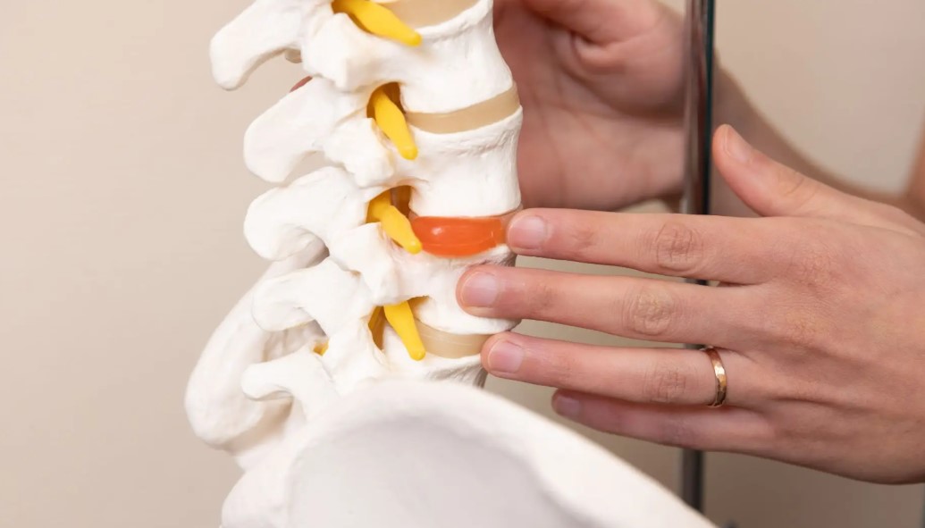 علائم دیسک کمر خفیف