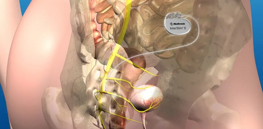 تحریک عصب ساکرال