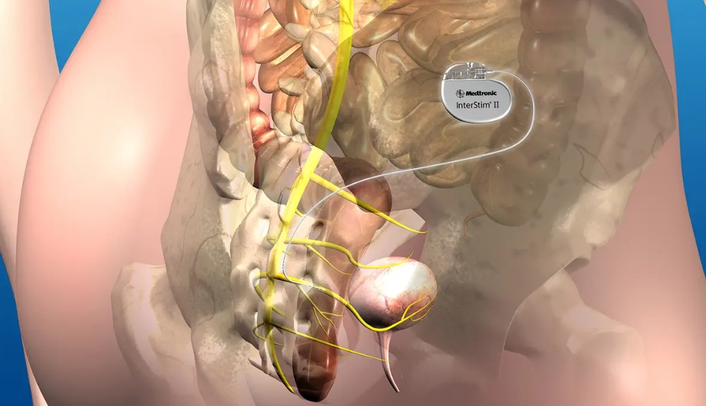 تحریک عصب ساکرال