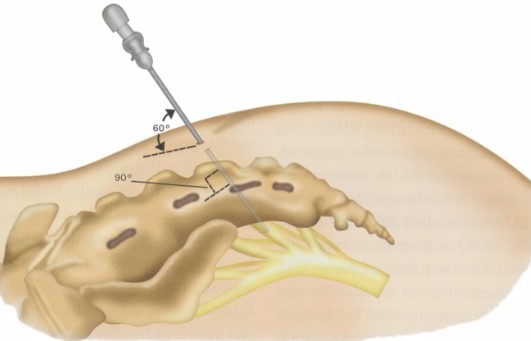 عکس تحریک عصب ساکرال
