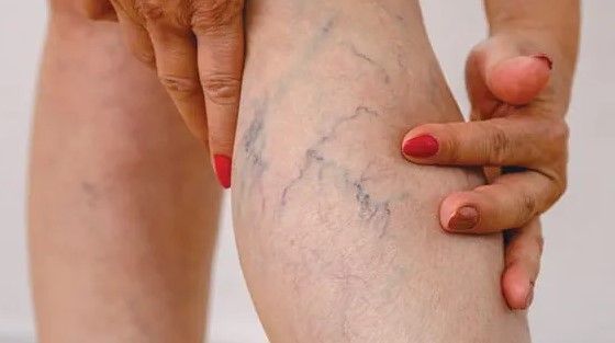 عکس واریس طنابی