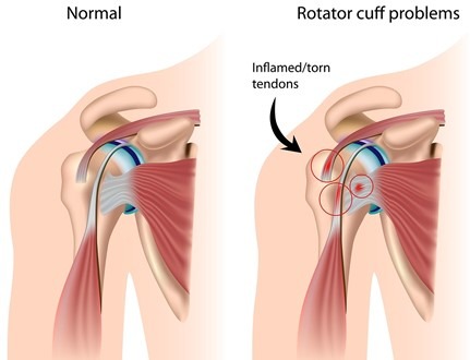 عکس پارگی کلاهک گرداننده شانه