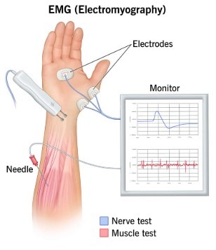 نمونه نوار عصب دست