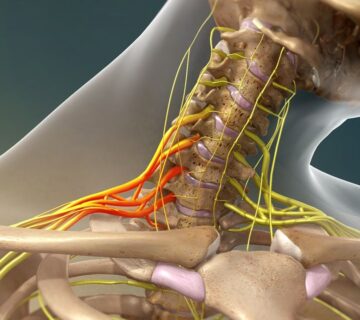 براکیال پلکسوس