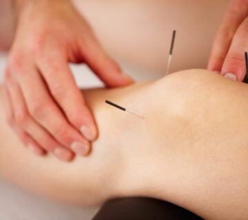 عکس سوزن درمانی