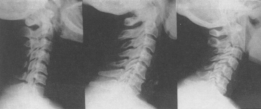 عکس آرتروز گردن