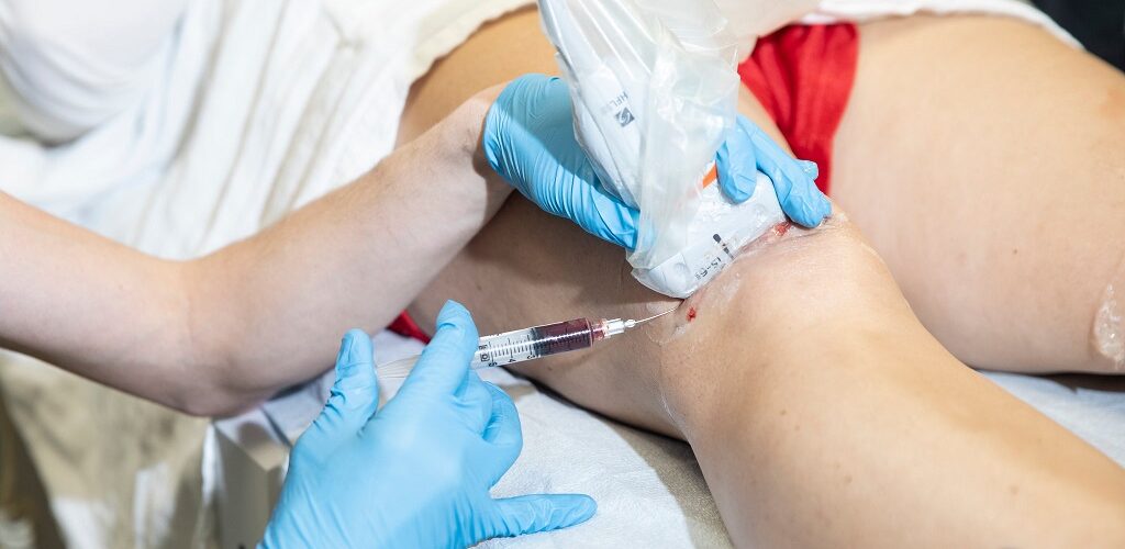 کاربرد سلول درمانی در ترمیم شکستگی های مزمن