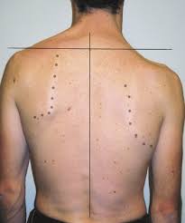 نمونه عکس افتادگی شانه