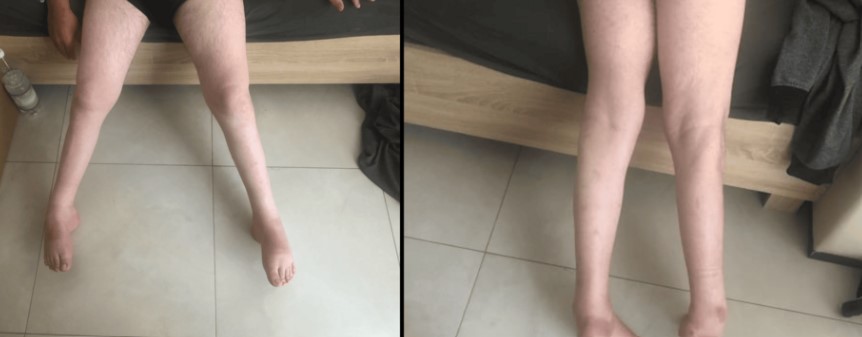 عکس بیماری میوپاتی