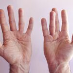 انقباض دوپویترن کف علت