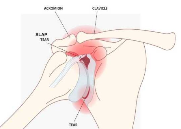 عکس پارگی لابروم
